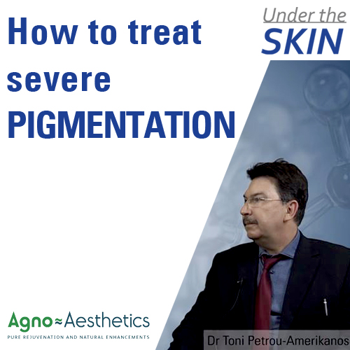 How to treat severe pigmentation- Dr. Petrou-Amerikanos